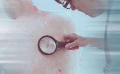 Magnifying glass over skin cancer.
